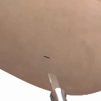 MIS minimally invasive bunion surgery animation. Stryker Prostep. Animation demonstrating MIS Bunion surgery including bone cuts and screw placement.