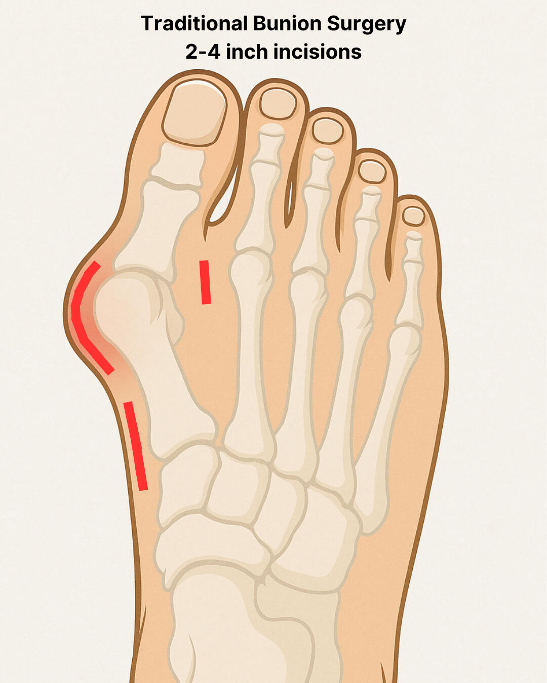 MIS minimally invasive bunion surgery animation. Stryker Prostep. Animation demonstrating MIS Bunion surgery including bone cuts and screw placement.